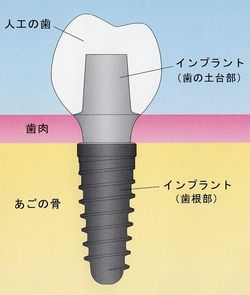 インプラント・人工歯根